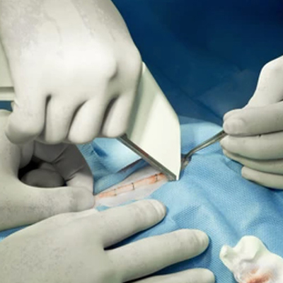 Medical cabinet/CHIRURGIE/Capsatoare, Clipuri si Decapsatoare Chirurgicale